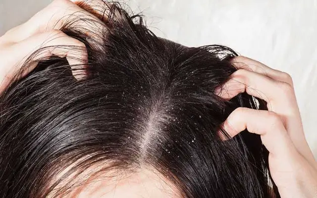 Best Oils for a Dry Scalp and Dandruff